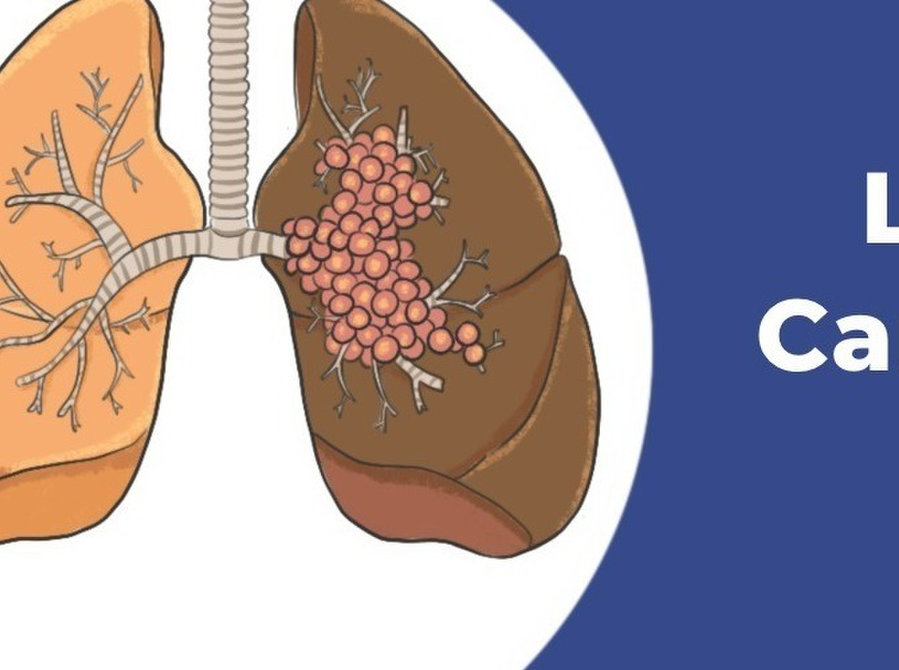 Best Lung Cancer Treatment Hospital in Delhi - Services: Other